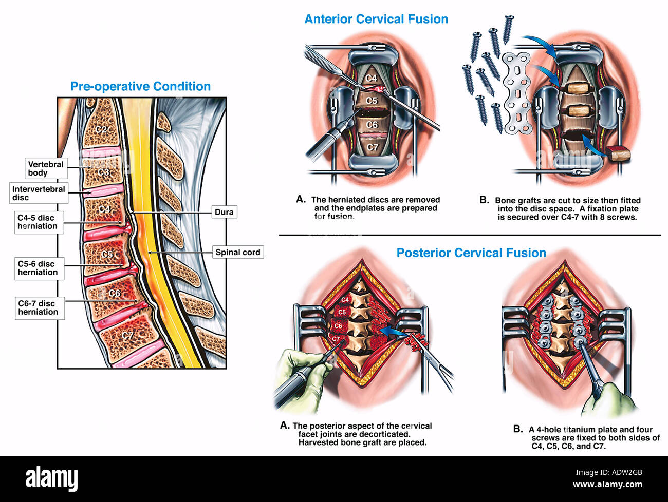 Herniated disc surgery