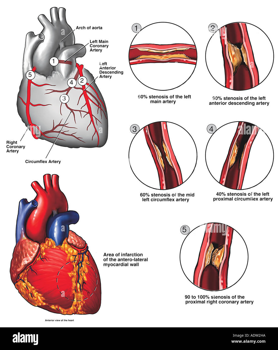 Atherosclerotic Coronary Artery Disease Stock Photo: 7711385 - Alamy