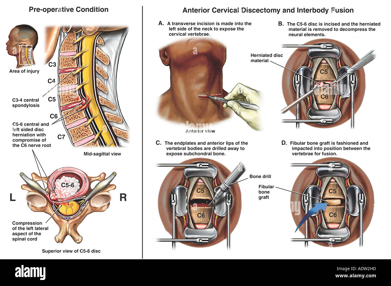 Herniations hires stock photography and images Alamy
