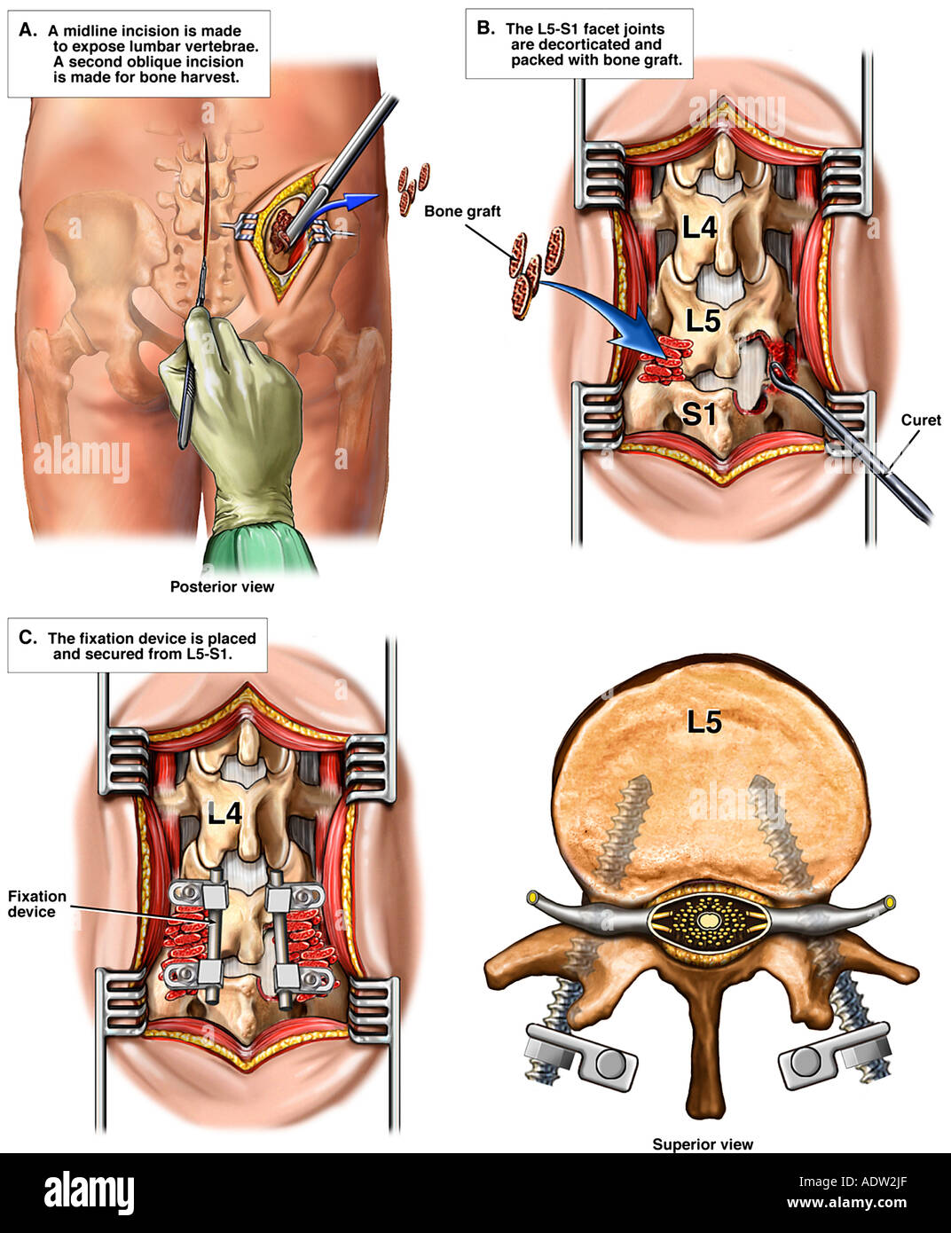 Recuperarea în hernia de disc lombară