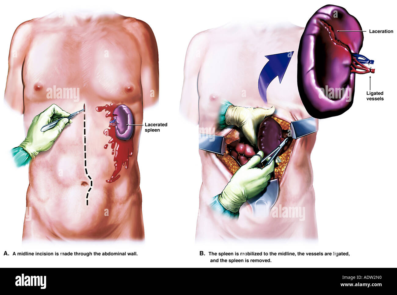 Как выглядит рак селезенки Spleen surgery hi-res stock photography and images - Alamy