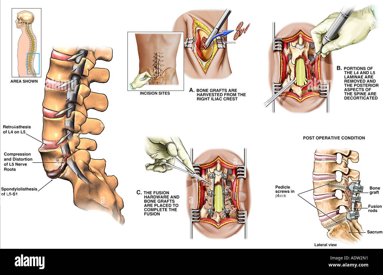 //c8.alamy.com/comp/ADW2N1/back-surgery-l5-s1-spondylolisthesis-with-surgical-repair-ADW2N1.jpg