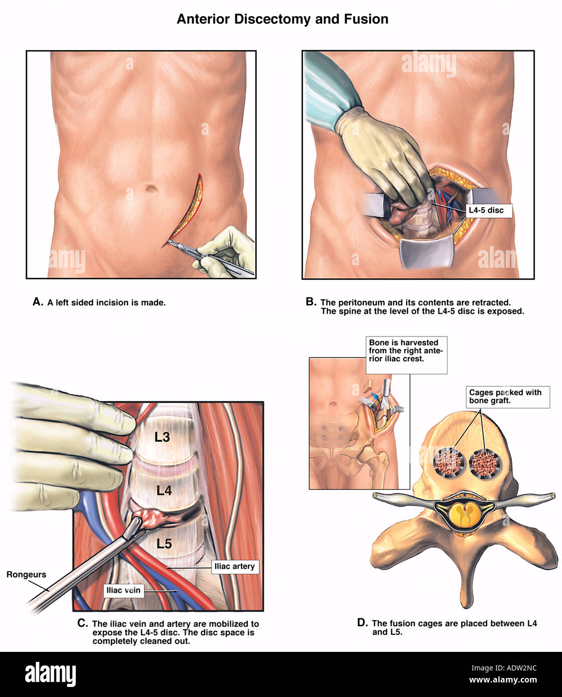 L4-5 Anterior Discectomy and Spinal Fusion Procedures Stock Photo