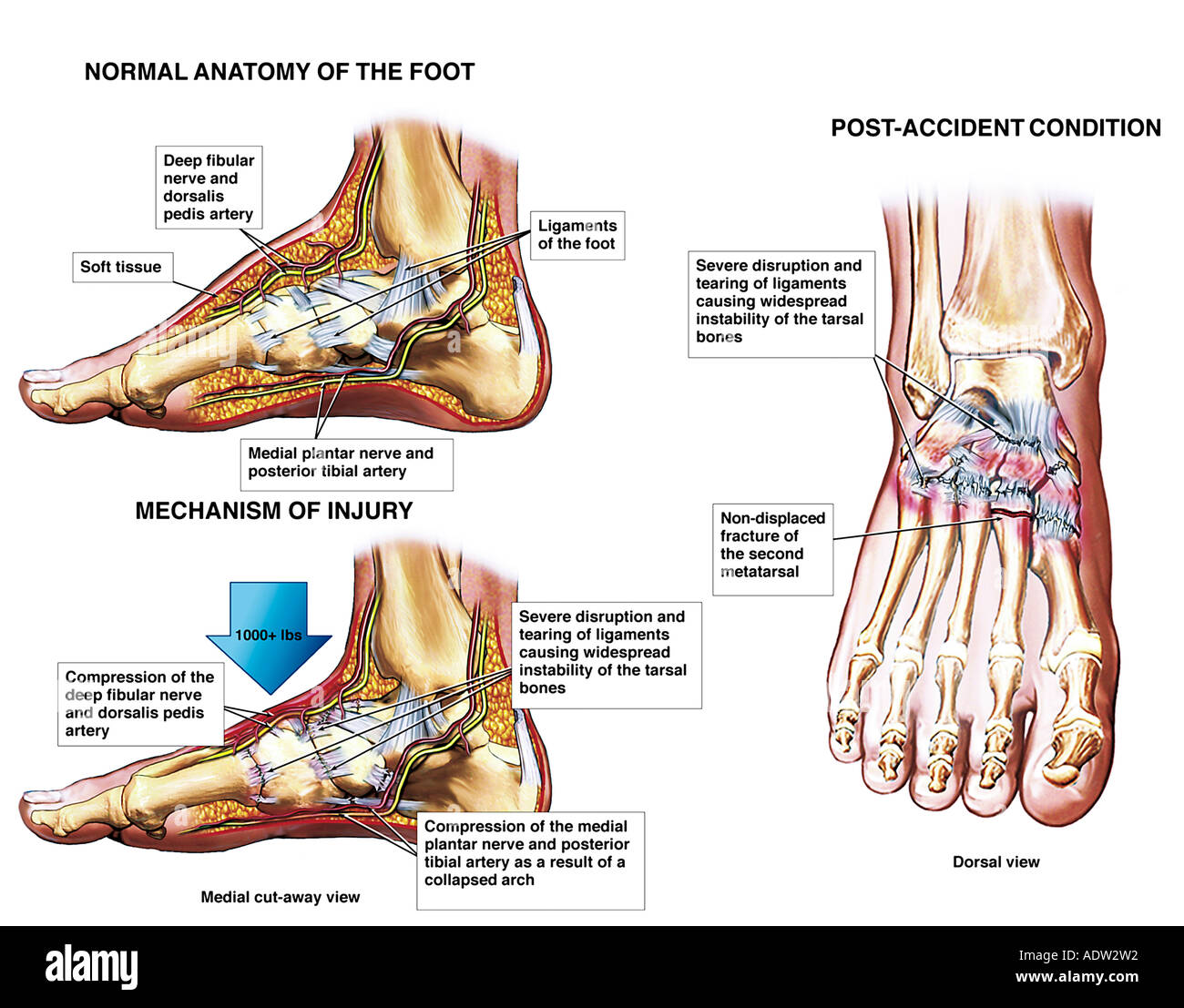 Crush Injuries High Resolution Stock Photography and Images Alamy