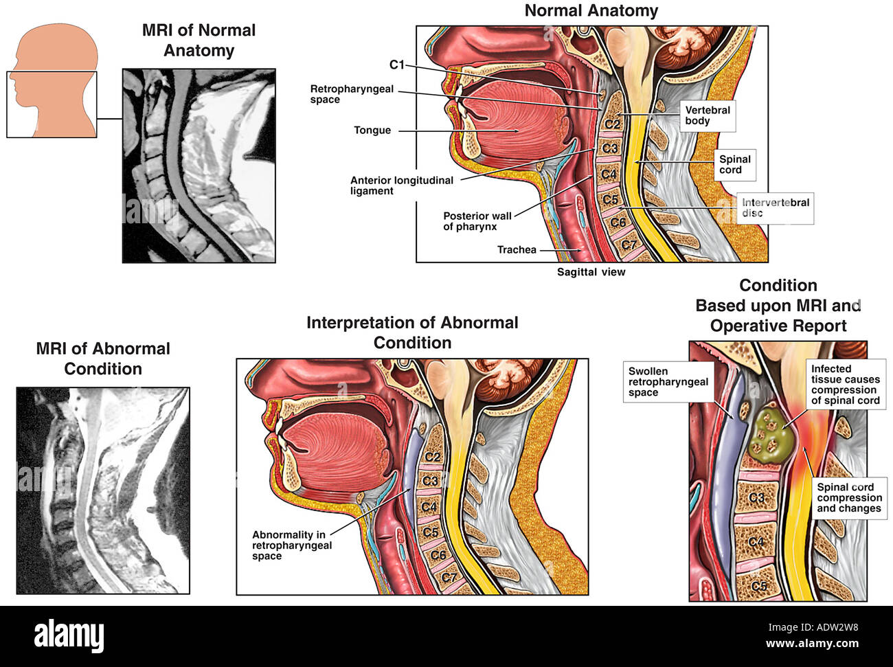 Abnormality in the Retropharyngeal Space Stock Photo