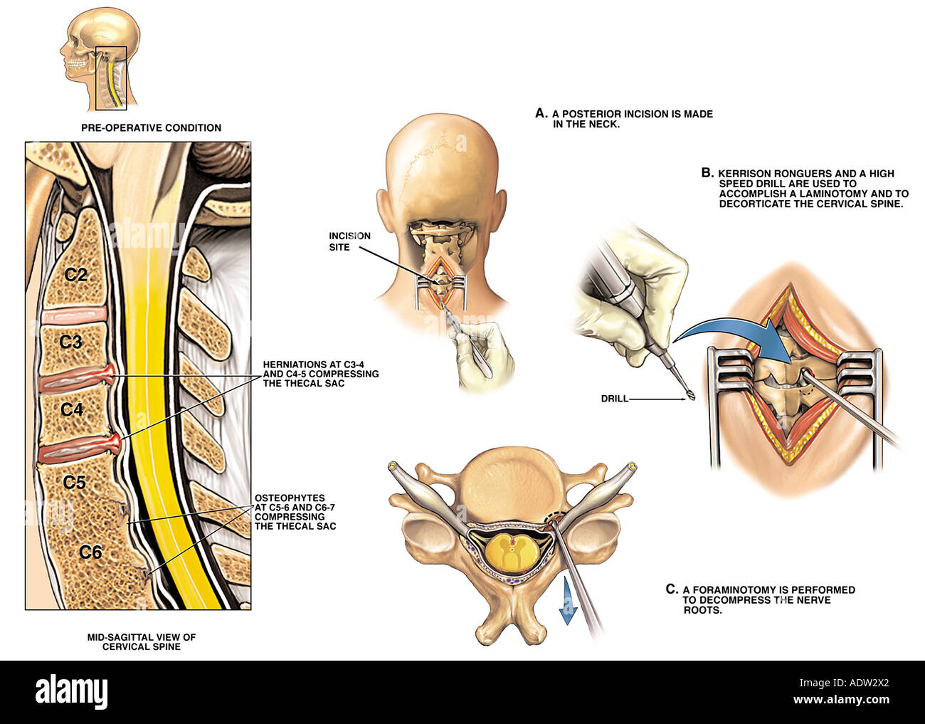 Cervical Osteophytes