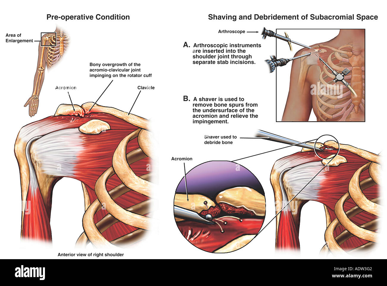 Shoulder Impingement Syndrome with Arthroscopic Surgery Stock Photo