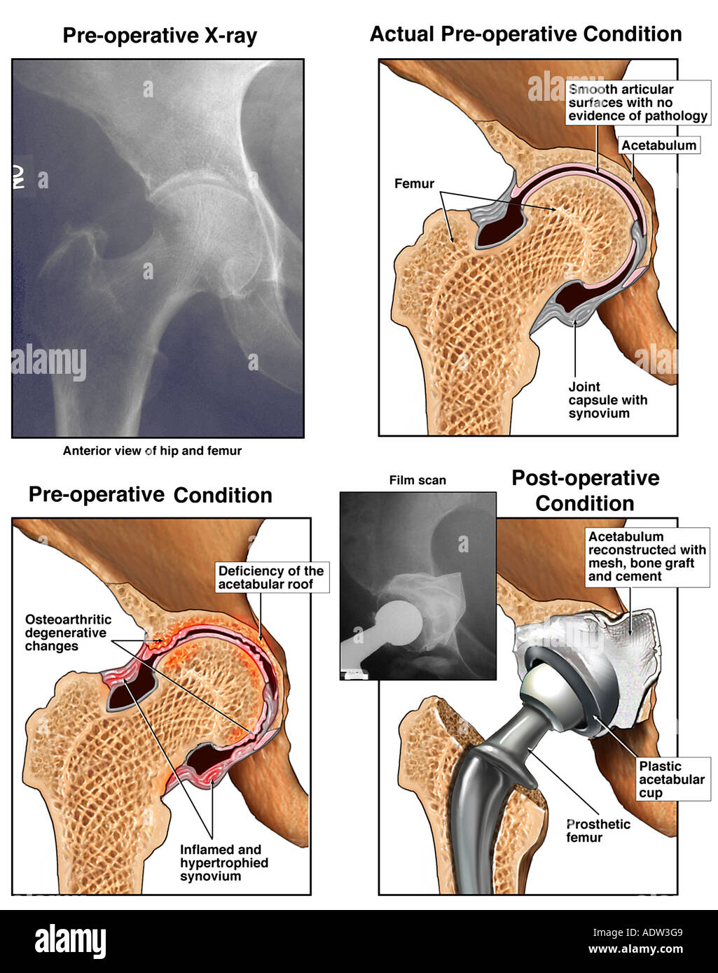 Arthrosis x ray hip hires stock photography and images Alamy