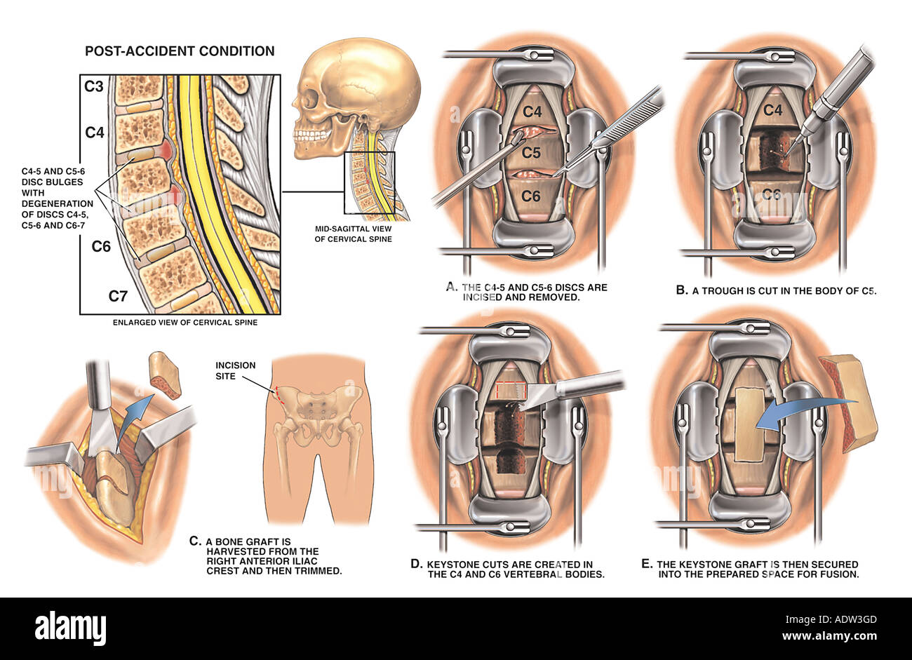 C4-5 and C5-6 Anterior Cervical Discectomy and Fusion Procedure Stock Photo