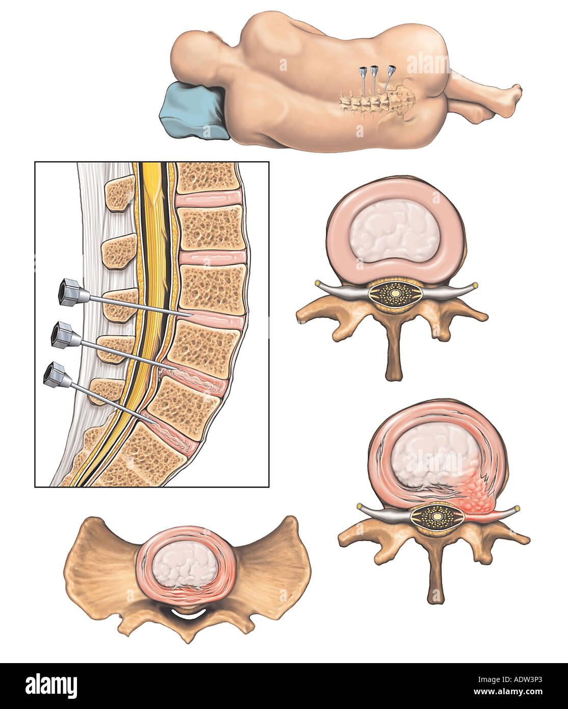 Discogram Meaning Lumbar Discogram Procedure _ Discogram (Spine X-ray): Why It’s Done ...