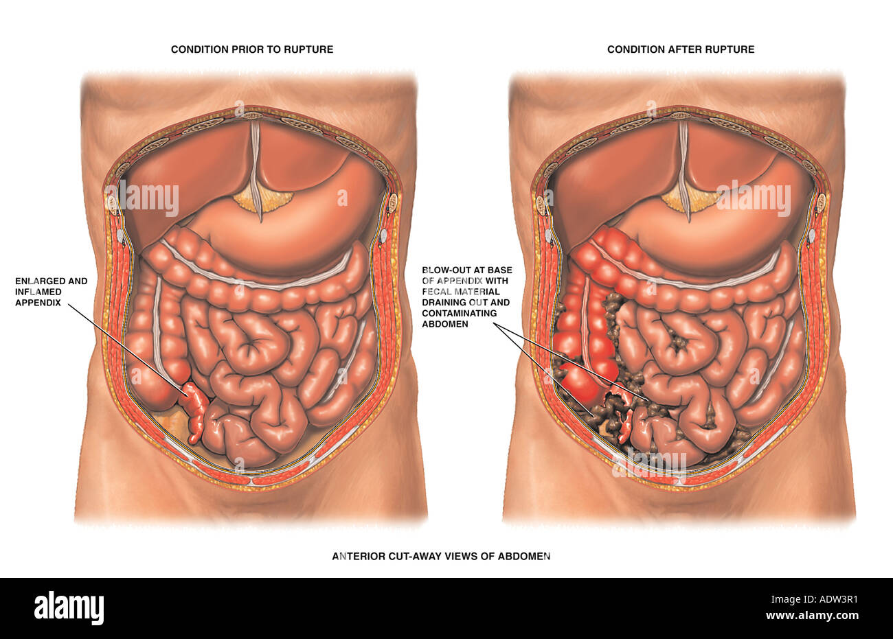 Ruptured appendix hi-res stock photography and images - Alamy