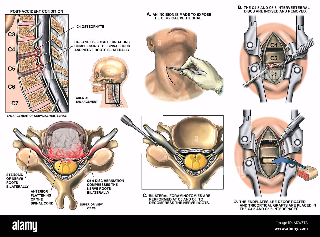 C And C Anterior Cervical Discectomy And Fusion Stock Photo Alamy