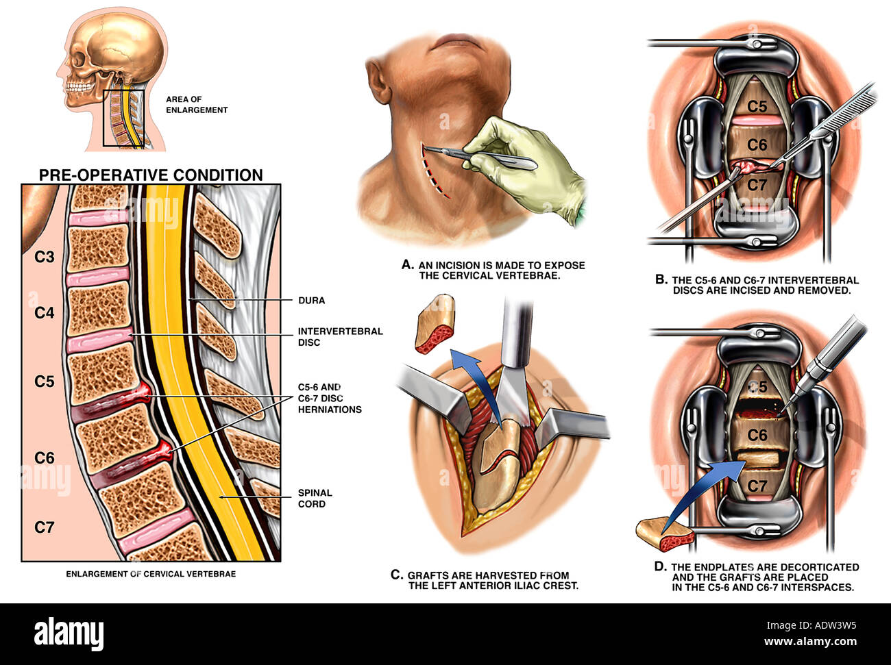 Discectomy hires stock photography and images Alamy