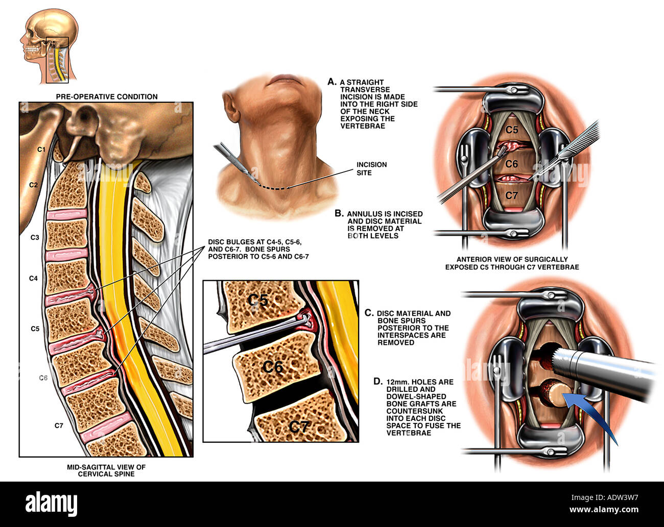 C56 and C67 Discectomy and Fusion Procedure Stock Photo 7711702 Alamy