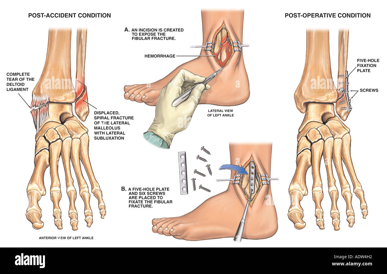 Post Accident Ankle Fracture With Open Reduction And Internal Stock My XXX Hot Girl