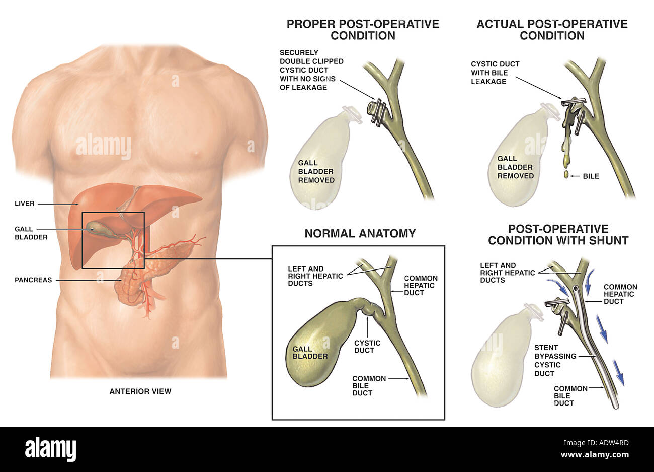 Операций post. Холецистэктомия анатомия. Этапы открытой холецистэктомии.