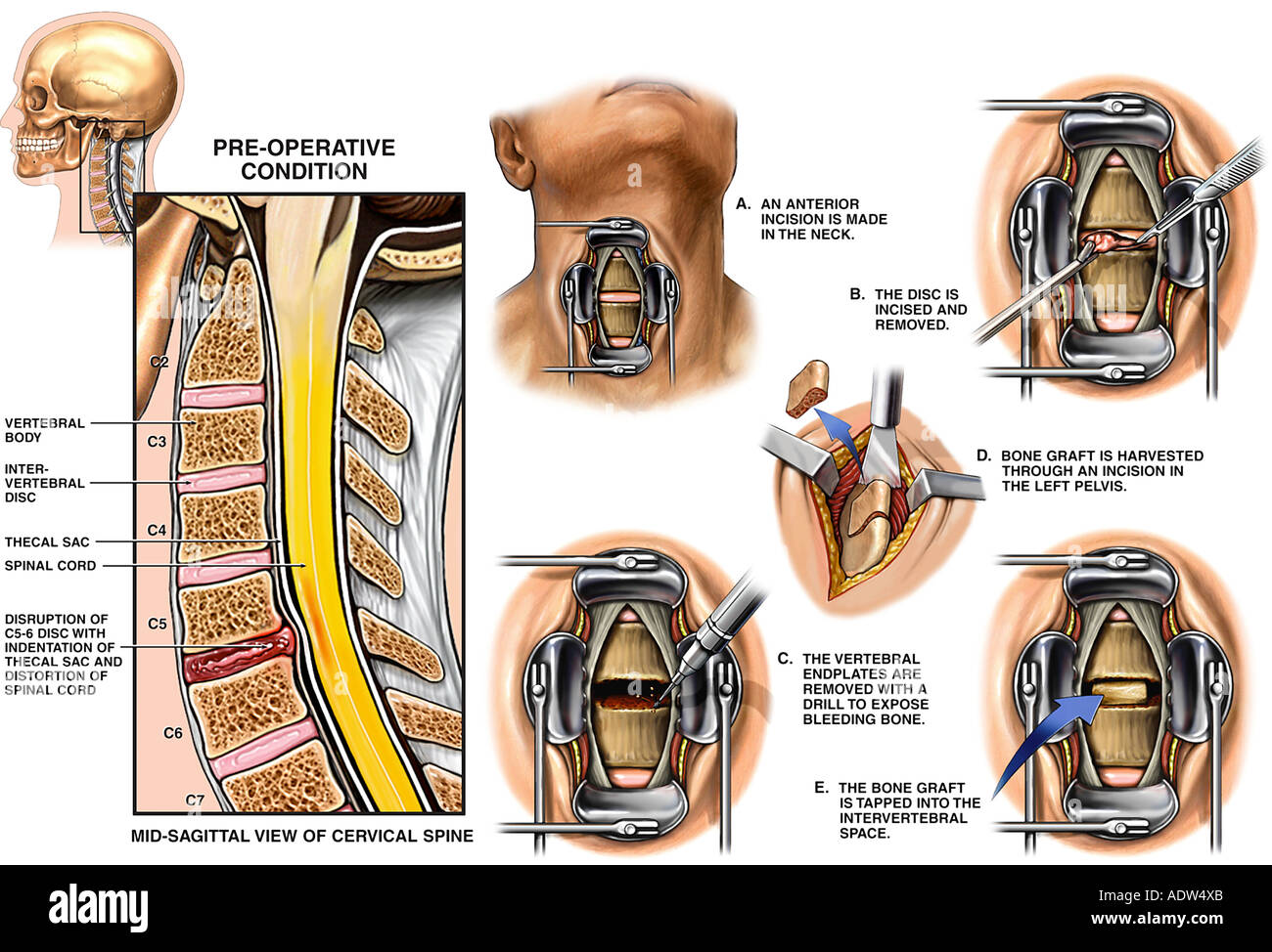 Spinal Fusion Surgery C5 6 Disc Herniation with Anterior Cervical Discectomy (Diskectomy) and Fusion Stock Photo