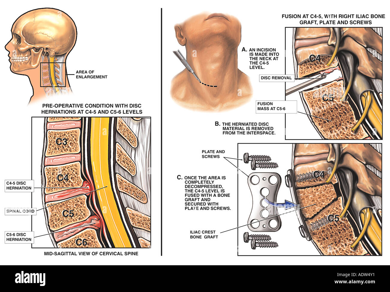 nadering Voldoen totaal Spine Surgery - Cervical Disc Protrusions at C4-5 and C5-6 with Spinal  Fusions Stock Photo - Alamy