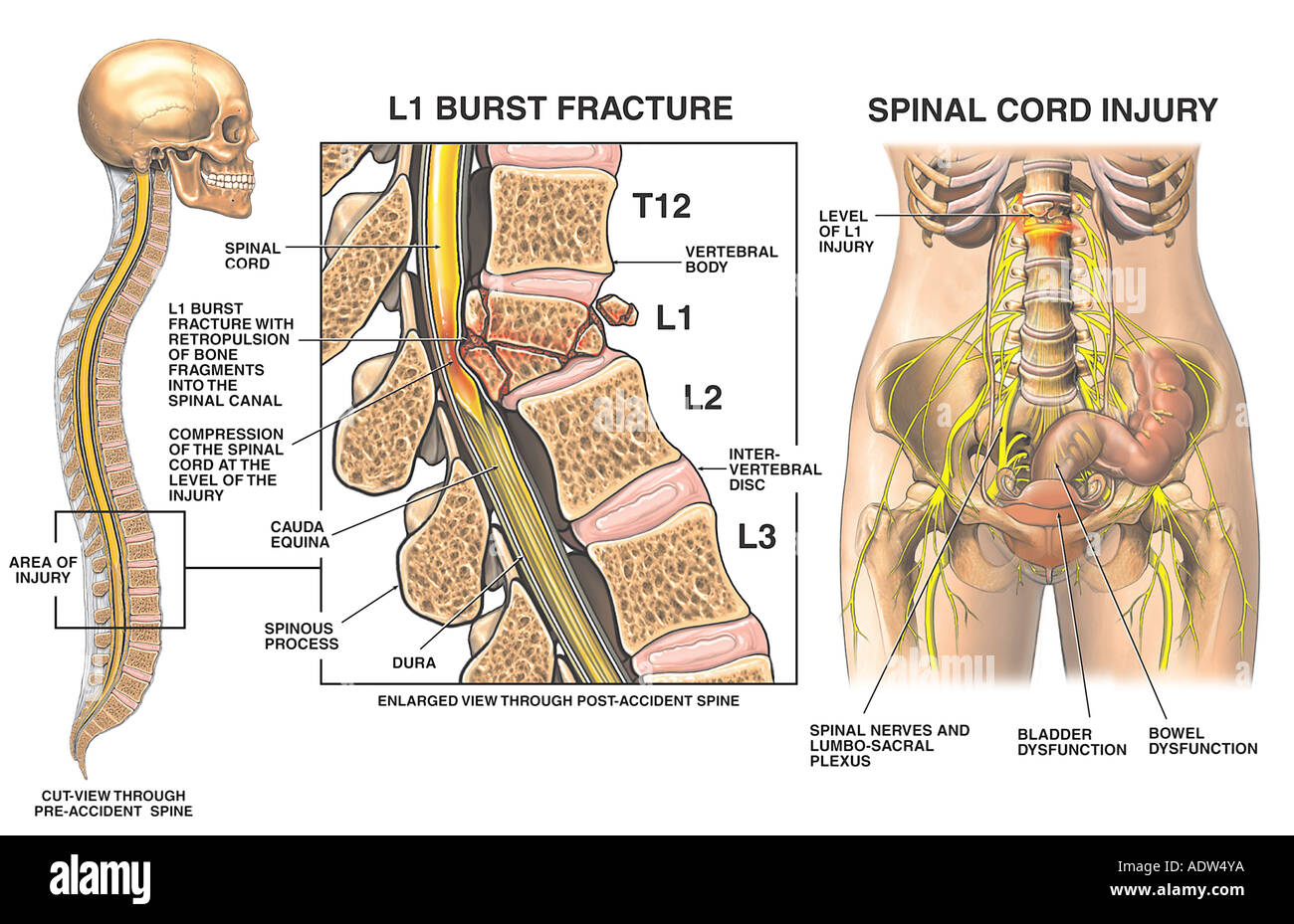 L1 Compression Burst Fracture with Spinal Cord Injury Stock Photo - Alamy