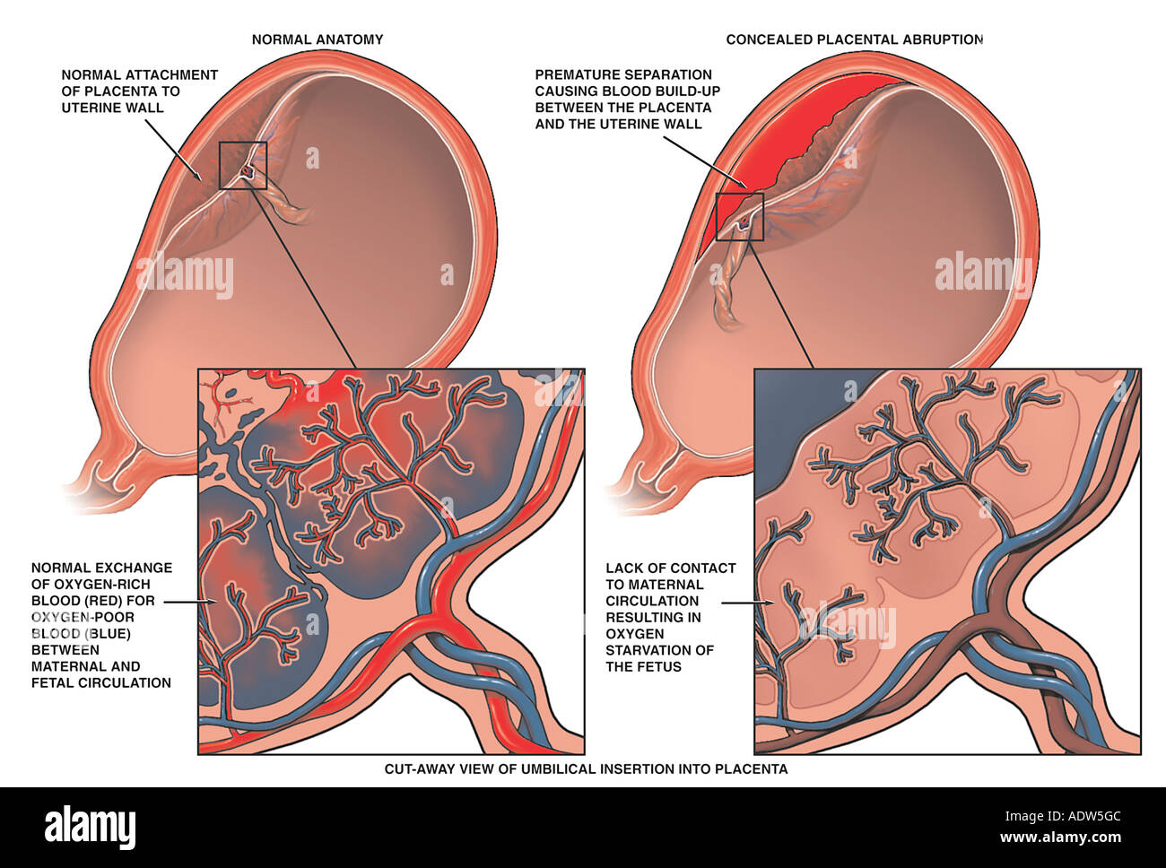 Normal Anatomy Of The Placenta Vs Placental Abruption Stock Photo 