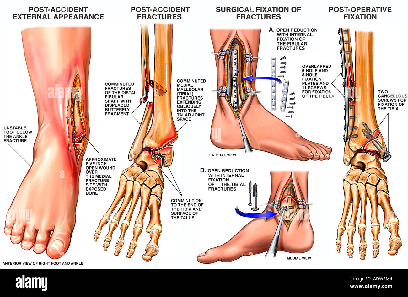 Open Fracture Dislocation of the Right Ankle Stock Photo - Alamy