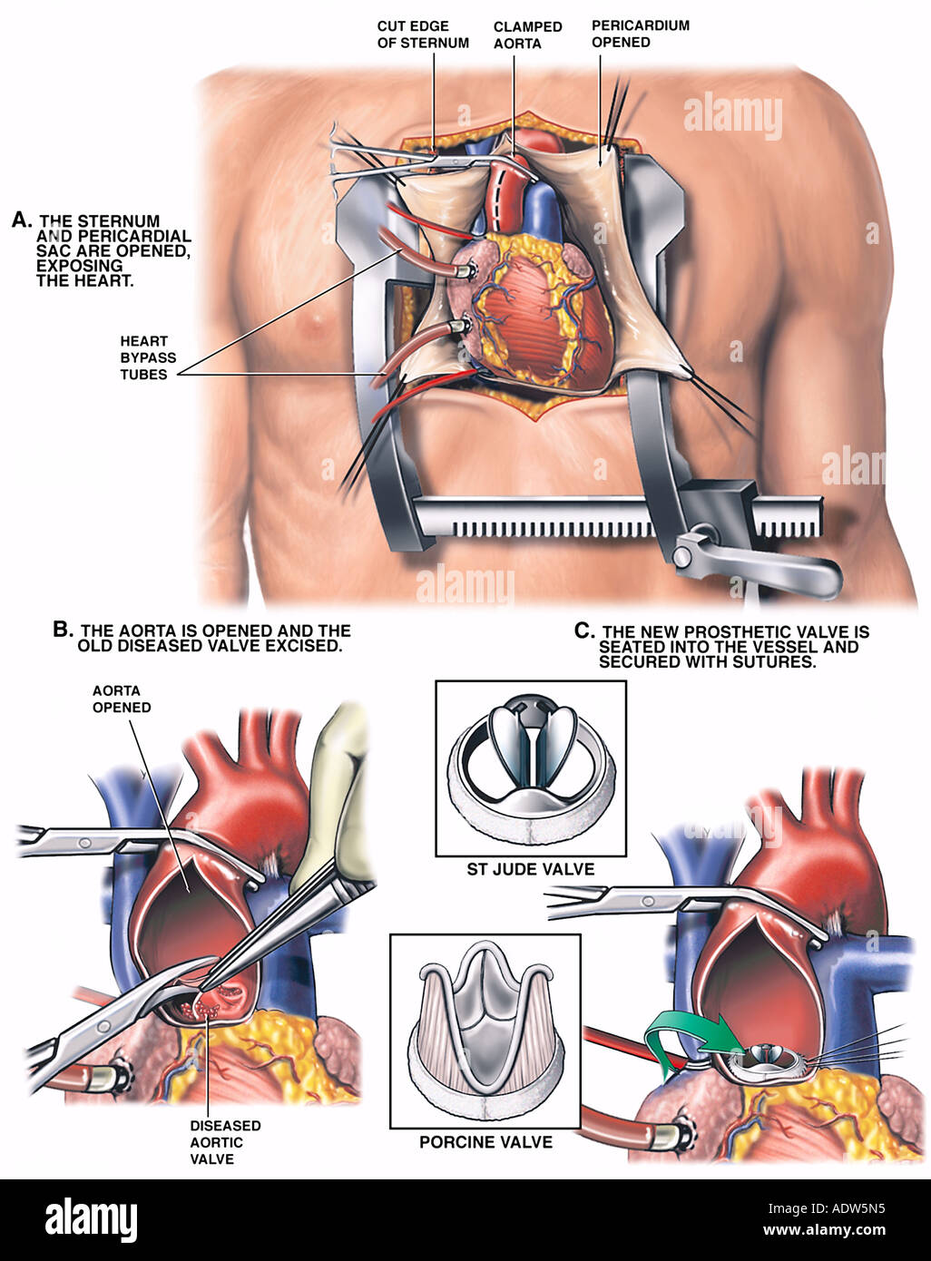 Cardiac Valve Replacement