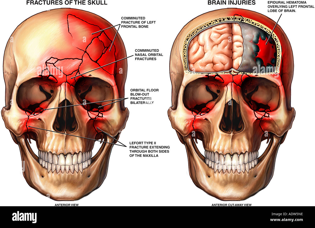 Head Injury Skull Fractures and Hematoma on the Brain Stock Photo