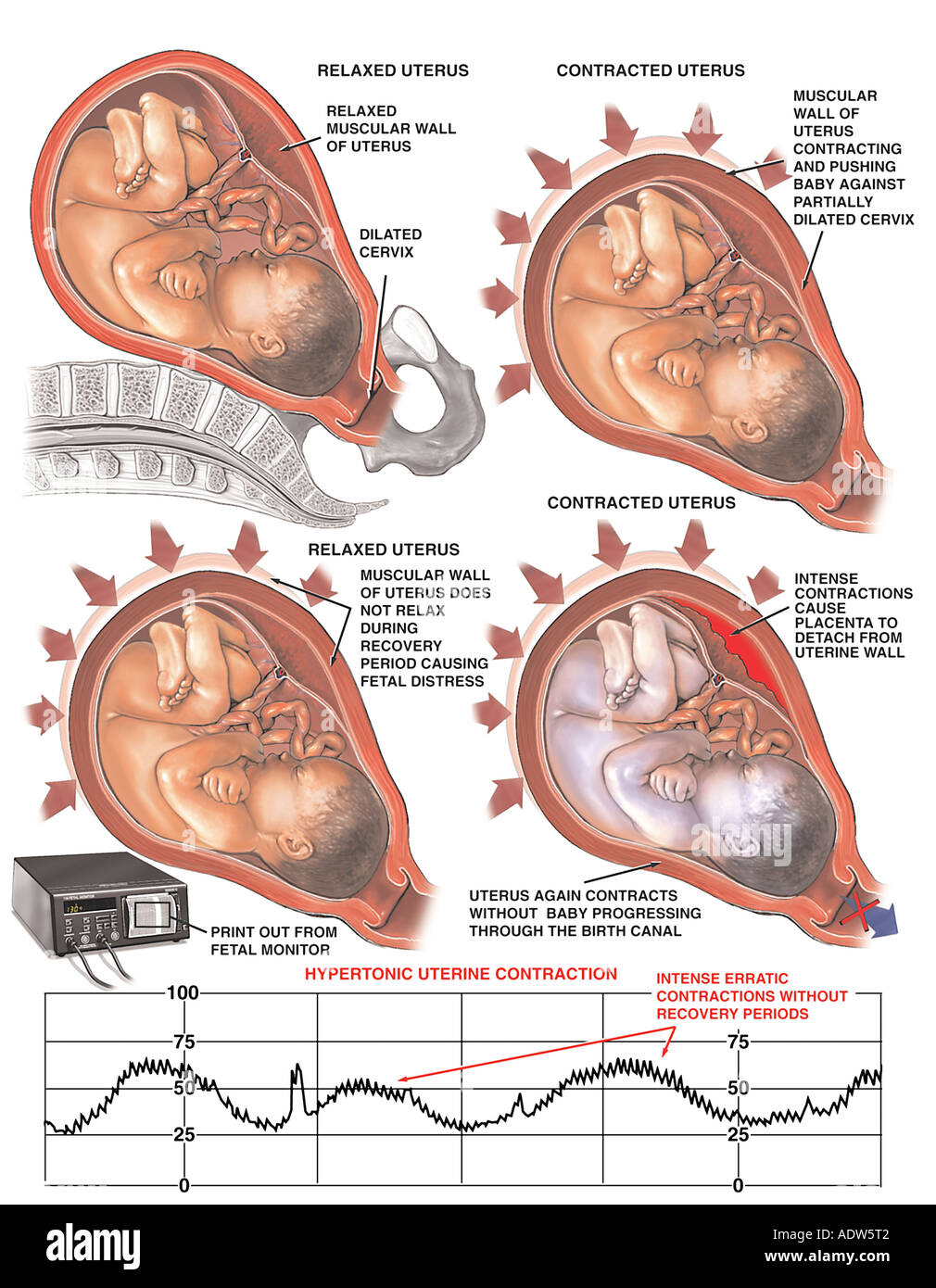 Hyperstimulation of the Uterus and Hypertonic Uterine Contractions