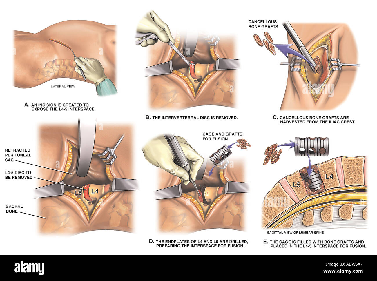 Back Surgery Anterior L4 5 Interbody Spinal Fusion Stock Photo