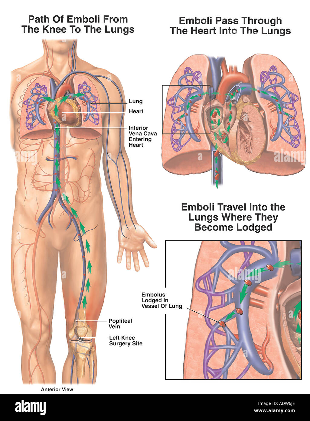 Pulmonary Embolism Resulting from Post-Operative Blood Clot Stock Photo
