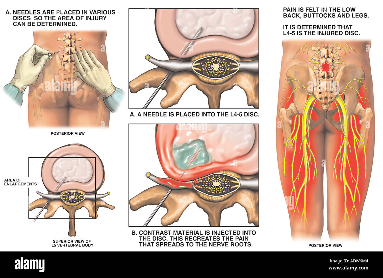 l4 disc herniated lumbar discogram posterior alamy cervical decompression herniations