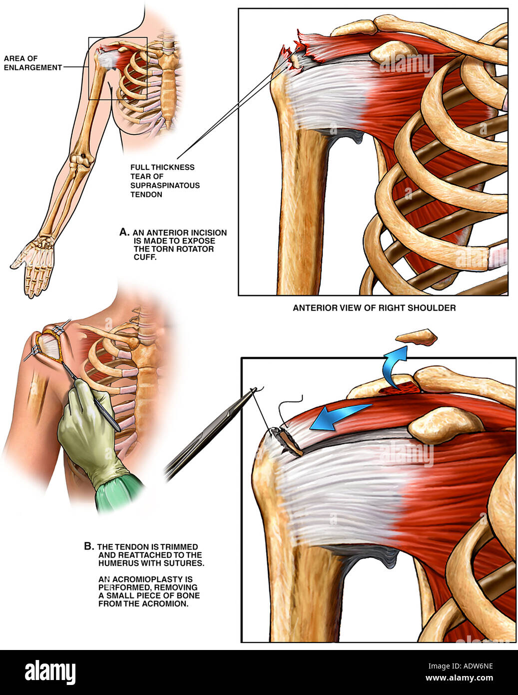 right rotator cuff tear