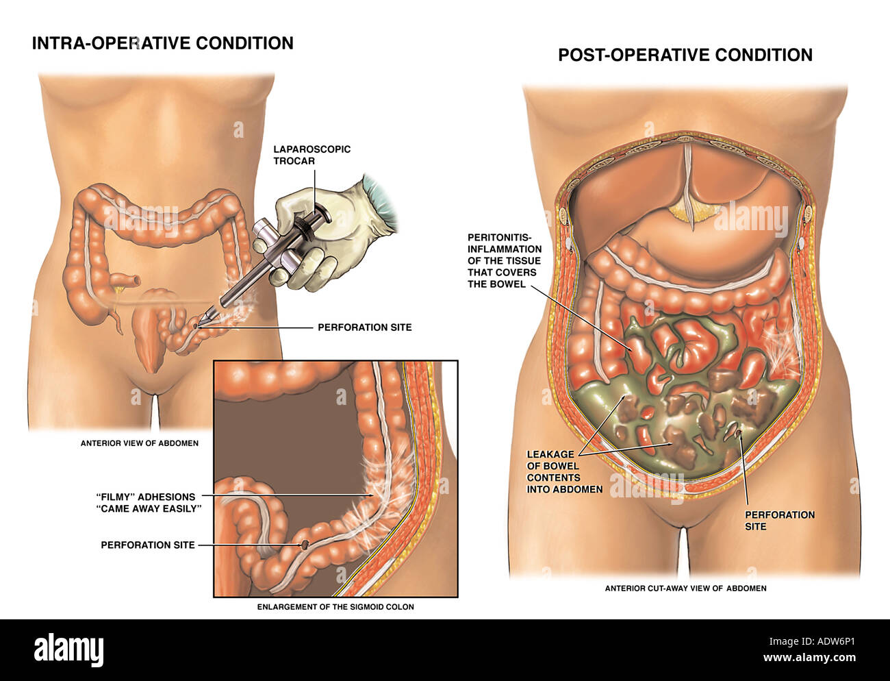 Bowel perforation hi-res stock photography and images - Alamy