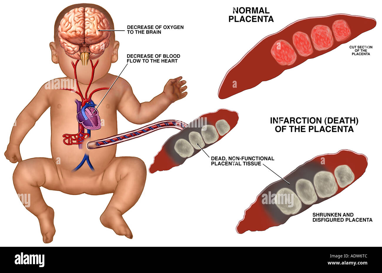 Геморрагический инфаркт плаценты