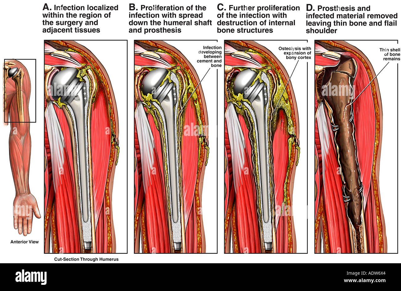 Rotator cuff repair surgery hires stock photography and images Alamy
