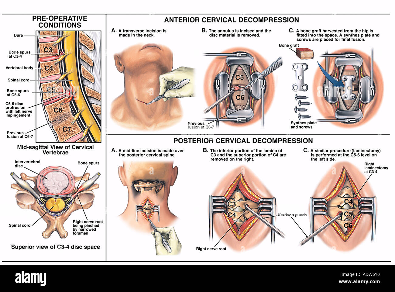 Neck Pain C5 6 Anterior and Posterior Cervical Decompression Surgery Stock Photo