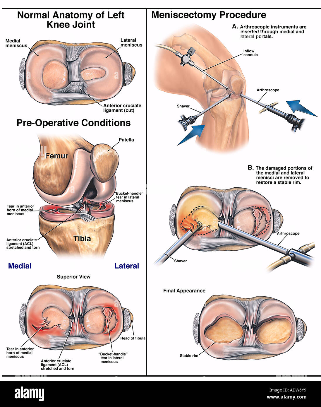 arthroscopic knee procedure