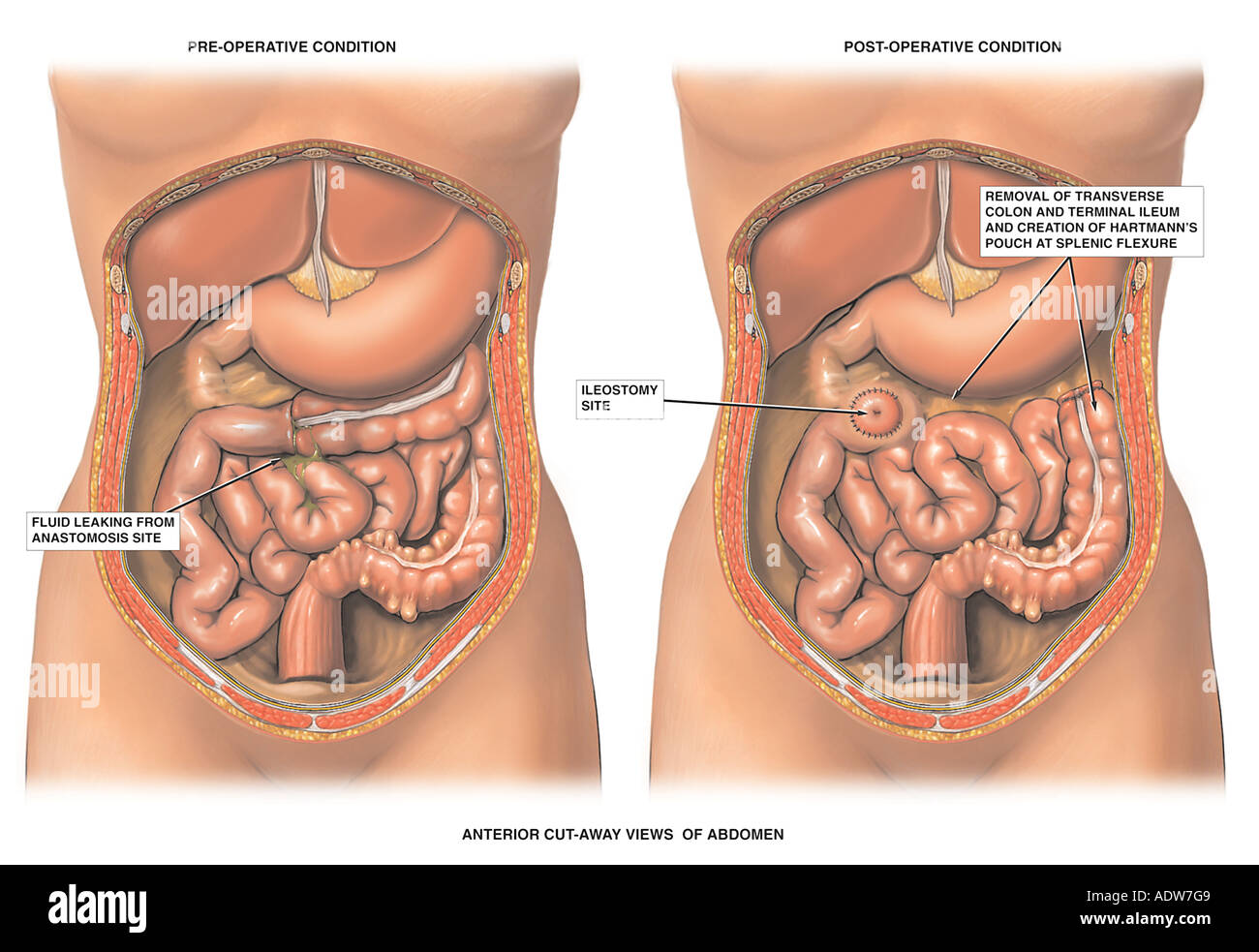 Anastomosis Leakage with Removal of Transverse Colon and Terminal Ileum  Stock Photo - Alamy