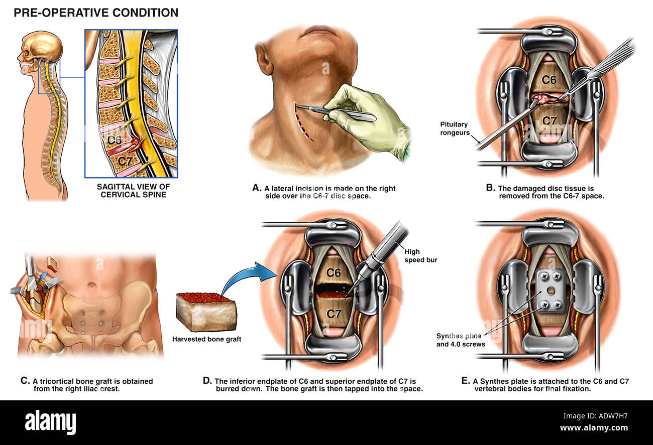 Spine Surgery - C6 7 Anterior Cervical Discectomy Diskectomy and Spinal Fusion with Synthes Plate Stock Photo