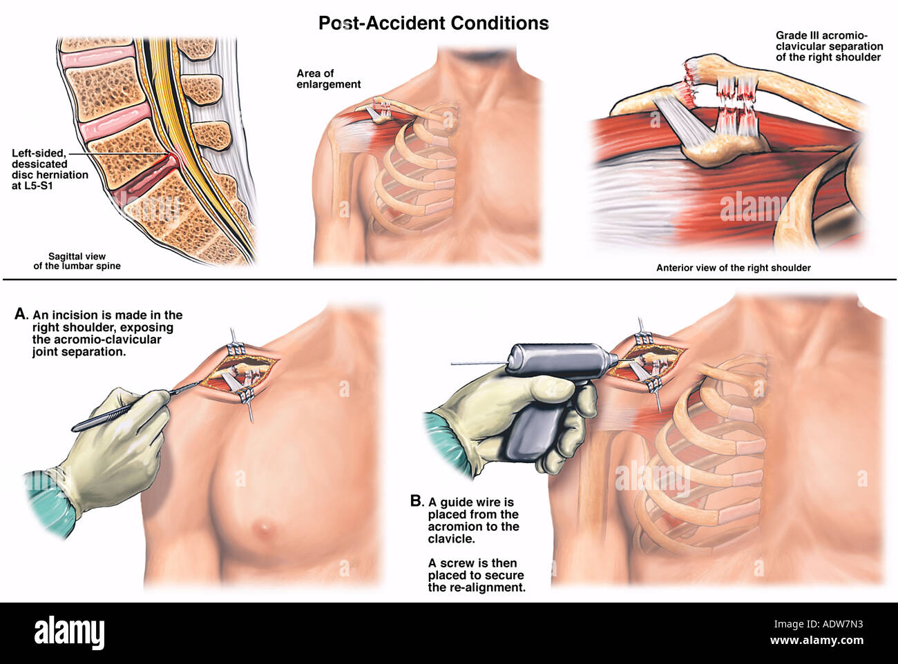 L5S1 Disc Herniation and Shoulder Injury with Subsequent Repair of