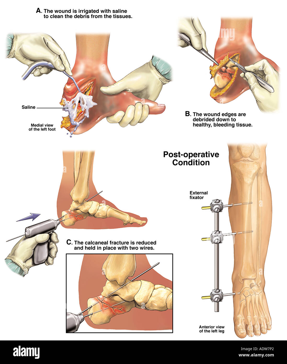 Lateral malleolus fracture hi-res stock photography and images - Alamy