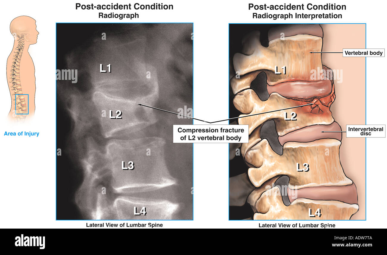 compression fracture treatment nj