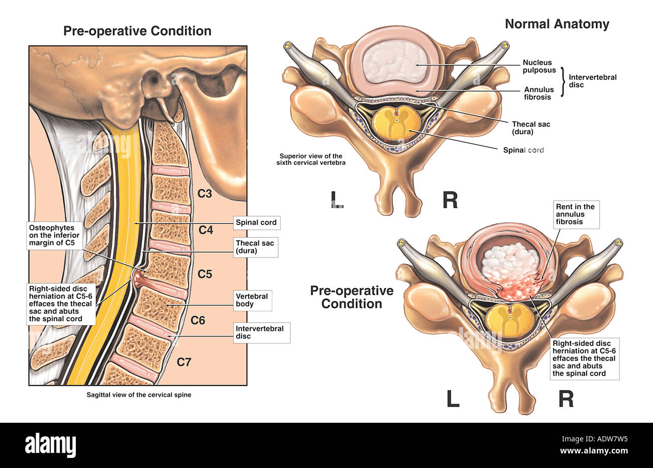Whiplash Injury C5 6 Disc Herniation Stock Photo Alamy