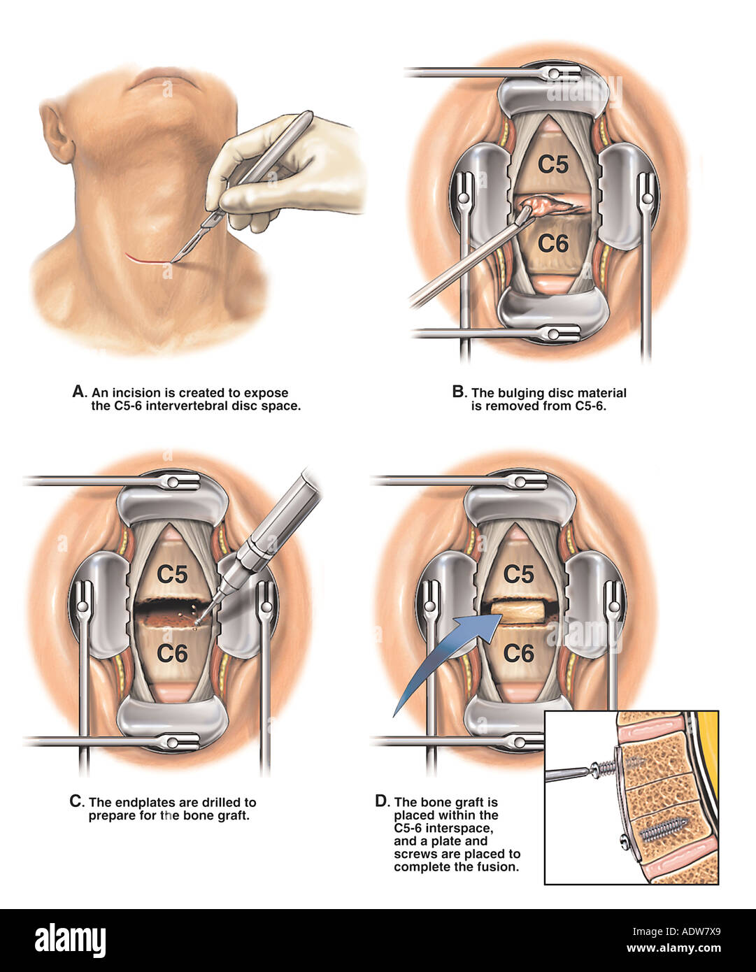 spinal-fusion-surgery-c5-6-anterior-cervical-discectomy-diskectomy