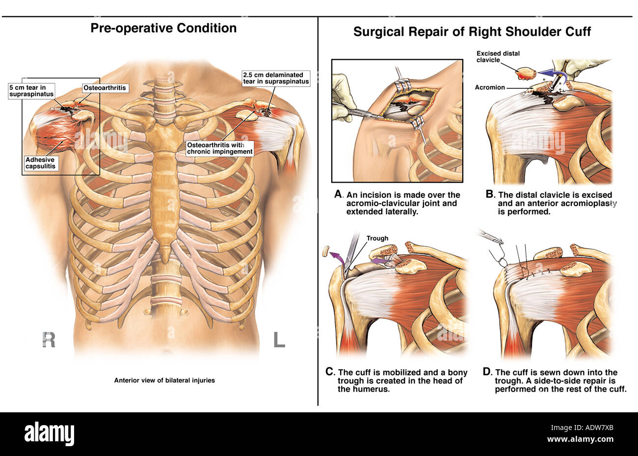 Rotator Cuff Surgery Stock Photo Alamy