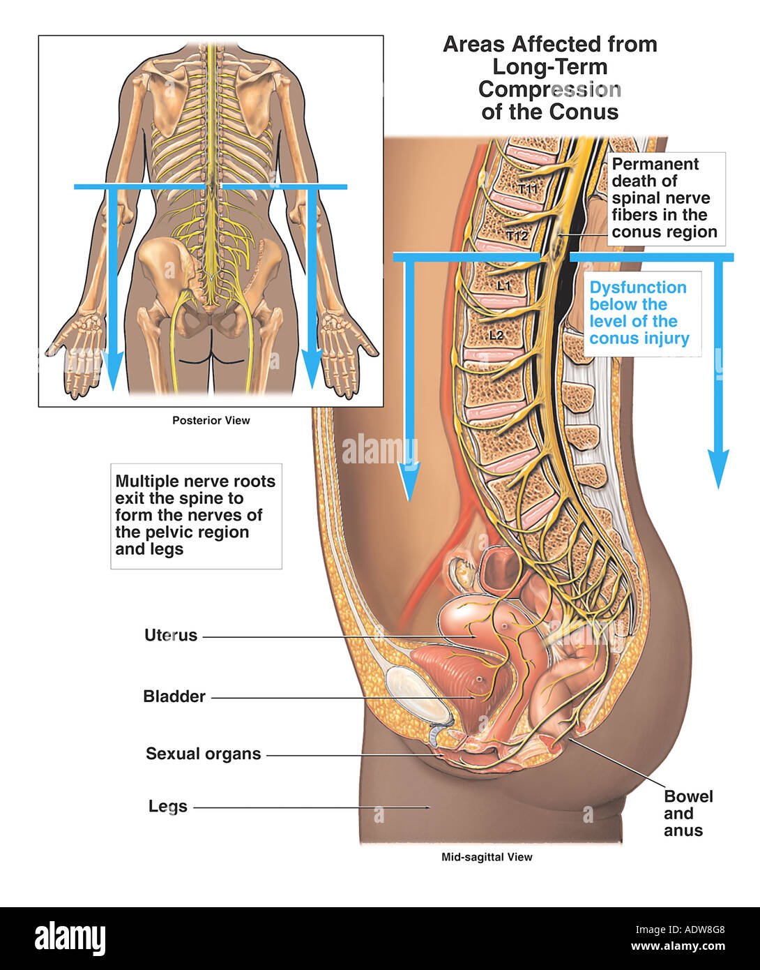 Spinal Cord Injury Long Term Effects Of Compression Stock Photo Alamy