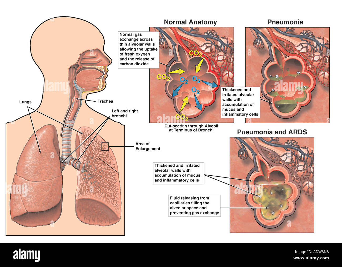 Pneumonia and Adult Respiratory Distress Syndrome (ARDS) Stock Photo