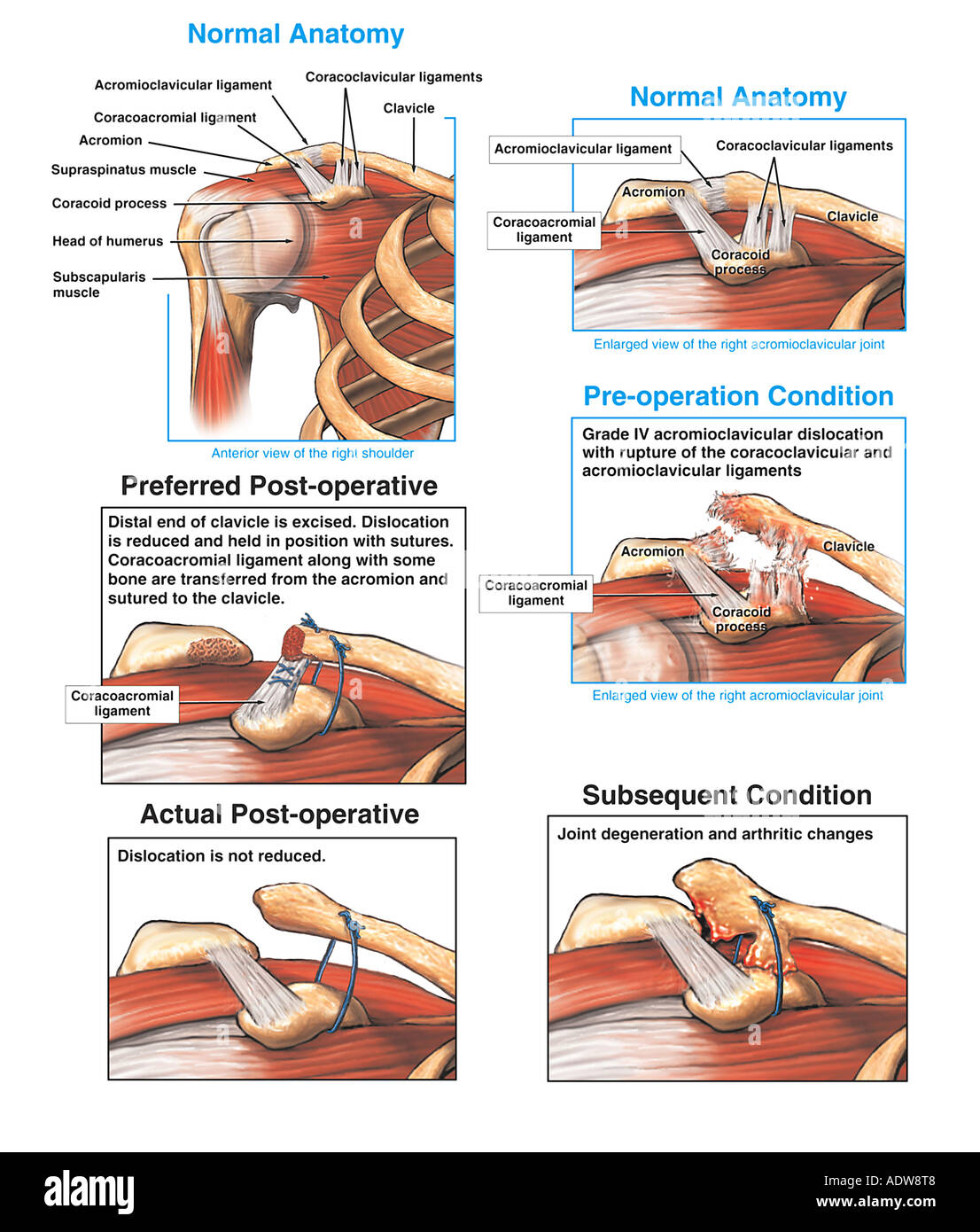 Shoulder Injury Dislocated Clavicle Collar Bone And Stock Photo