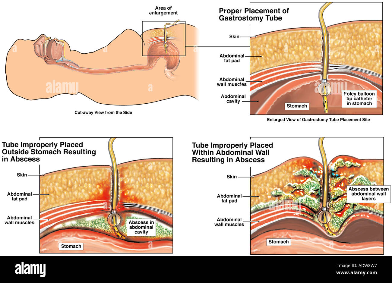 proper vs improper placement of gastrostomy tube and post operative gastrostomy