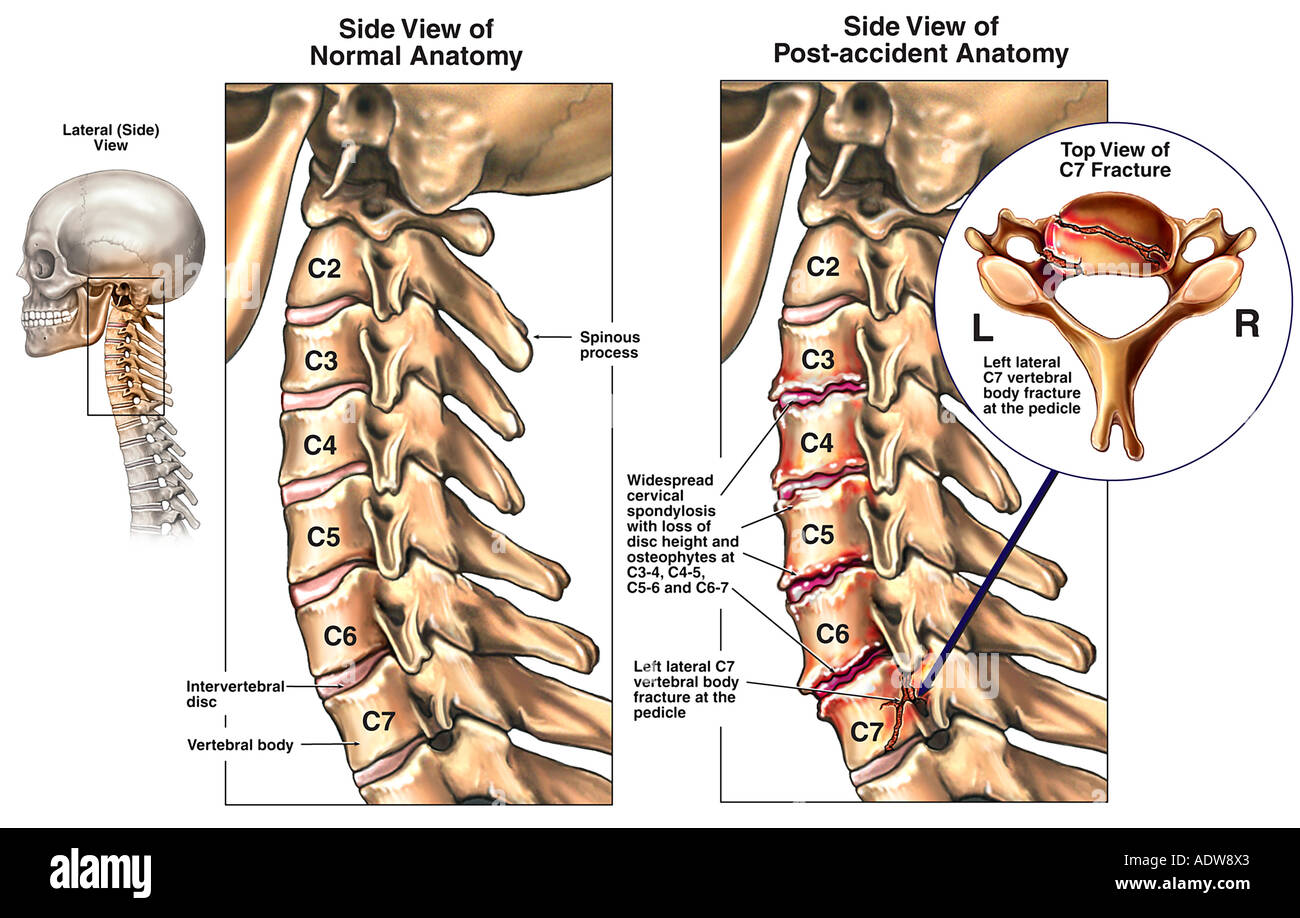 Anterior Osteophytes Cervical Spine